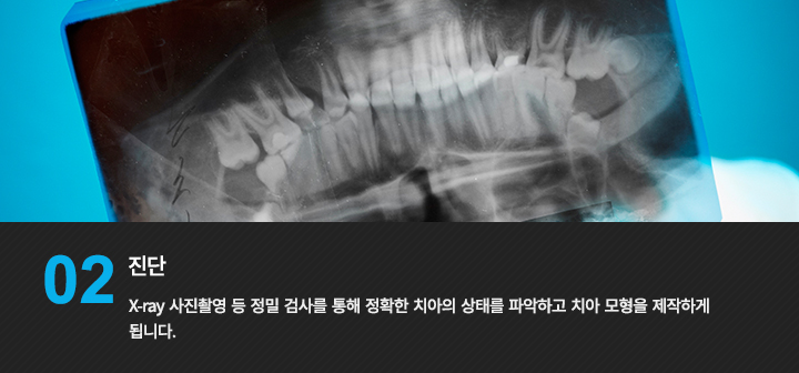 2. 진단 
X-ray 사진촬영 등 정밀 검사를 통해 정확한 치아의 상태를 파악하고 치아 모형을 제작하게 됩니다.
